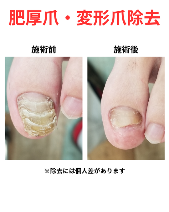 葛飾区亀有のトータルフットケア専門院｜巻き爪・肥厚爪・外反母趾なら